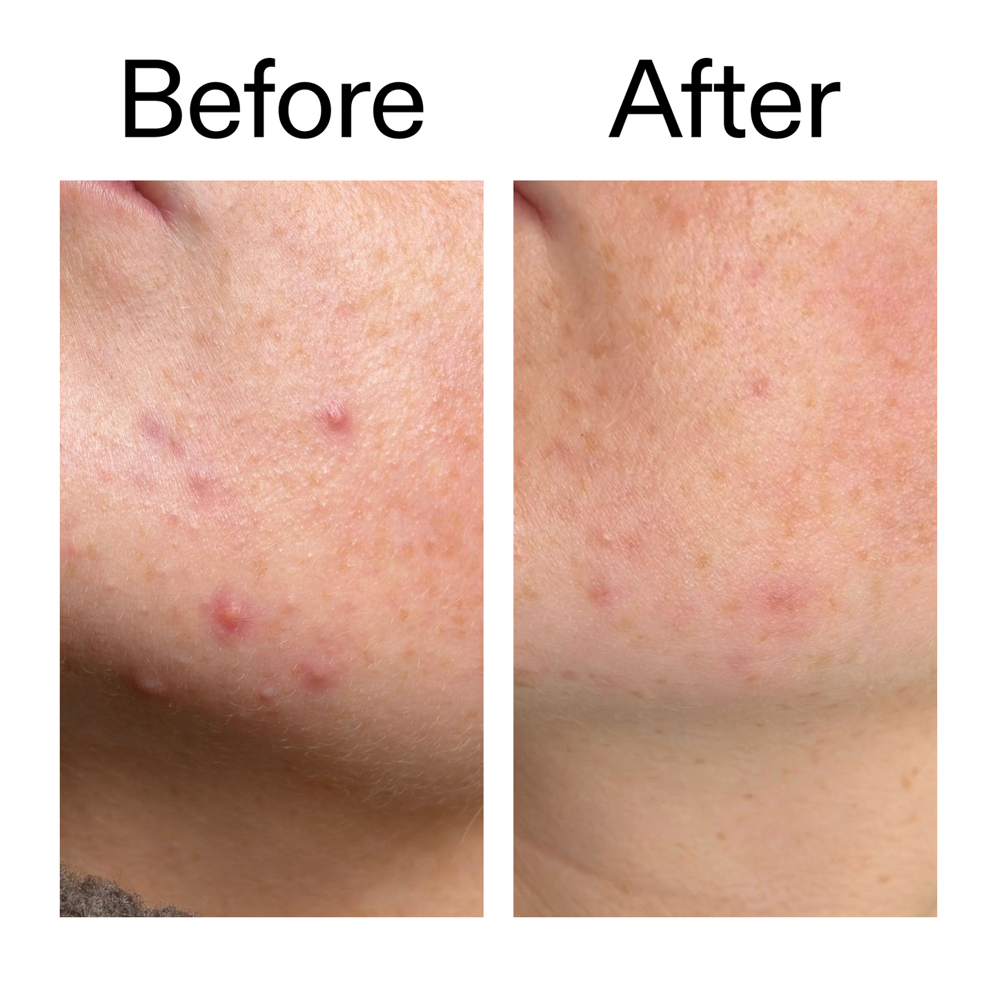10-azelaic-acid-serum-for-redness-relief-y3 B_A_1_PPAGE.png