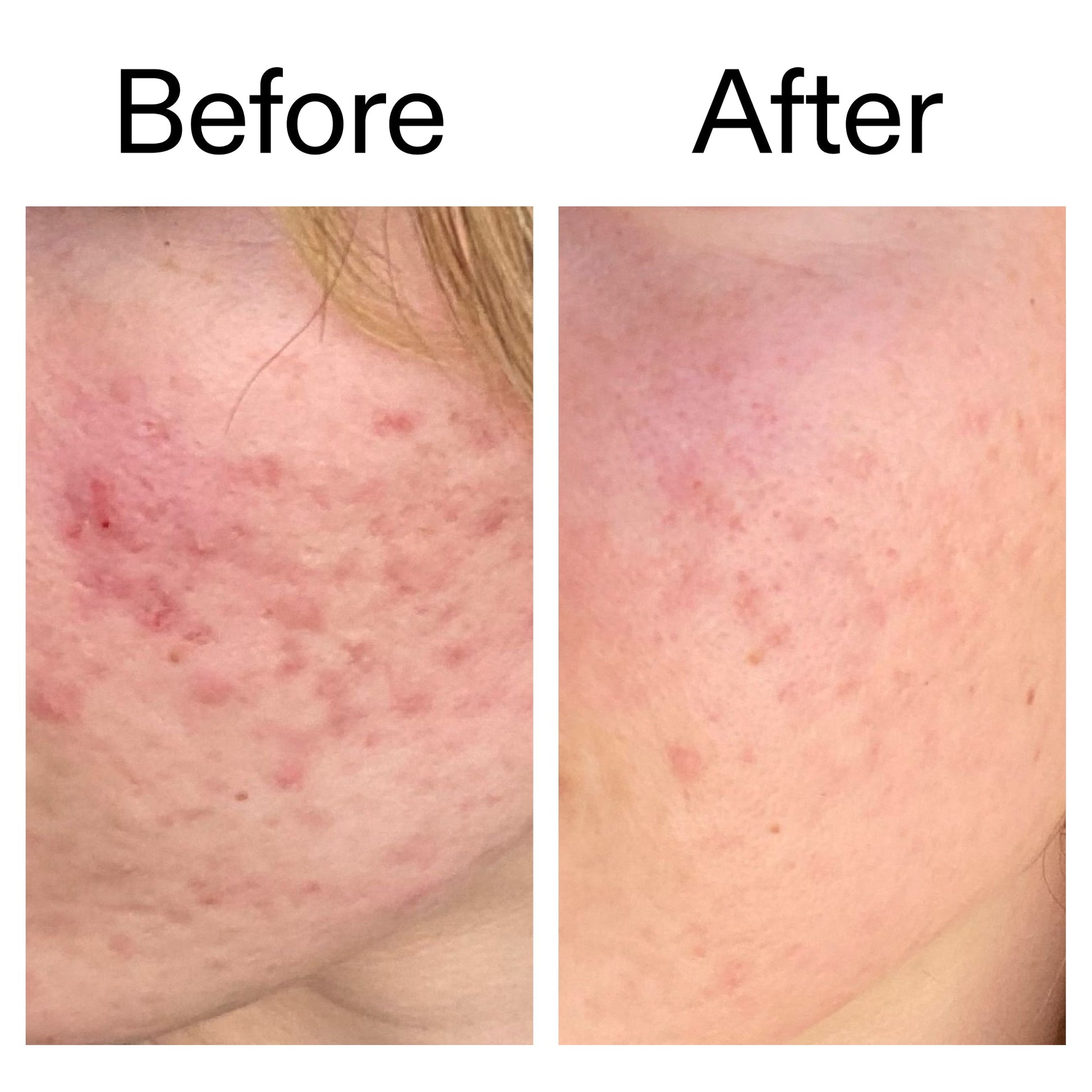 10-azelaic-acid-serum-for-redness-relief-y3 Azealic_Acid_Serum_B_A_Ppage_2000_x_2000.jpg