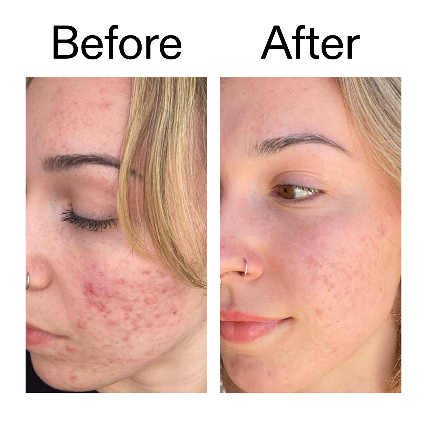 10-azelaic-acid-serum-for-redness-relief-y3 B_A_2_PPAGE.png