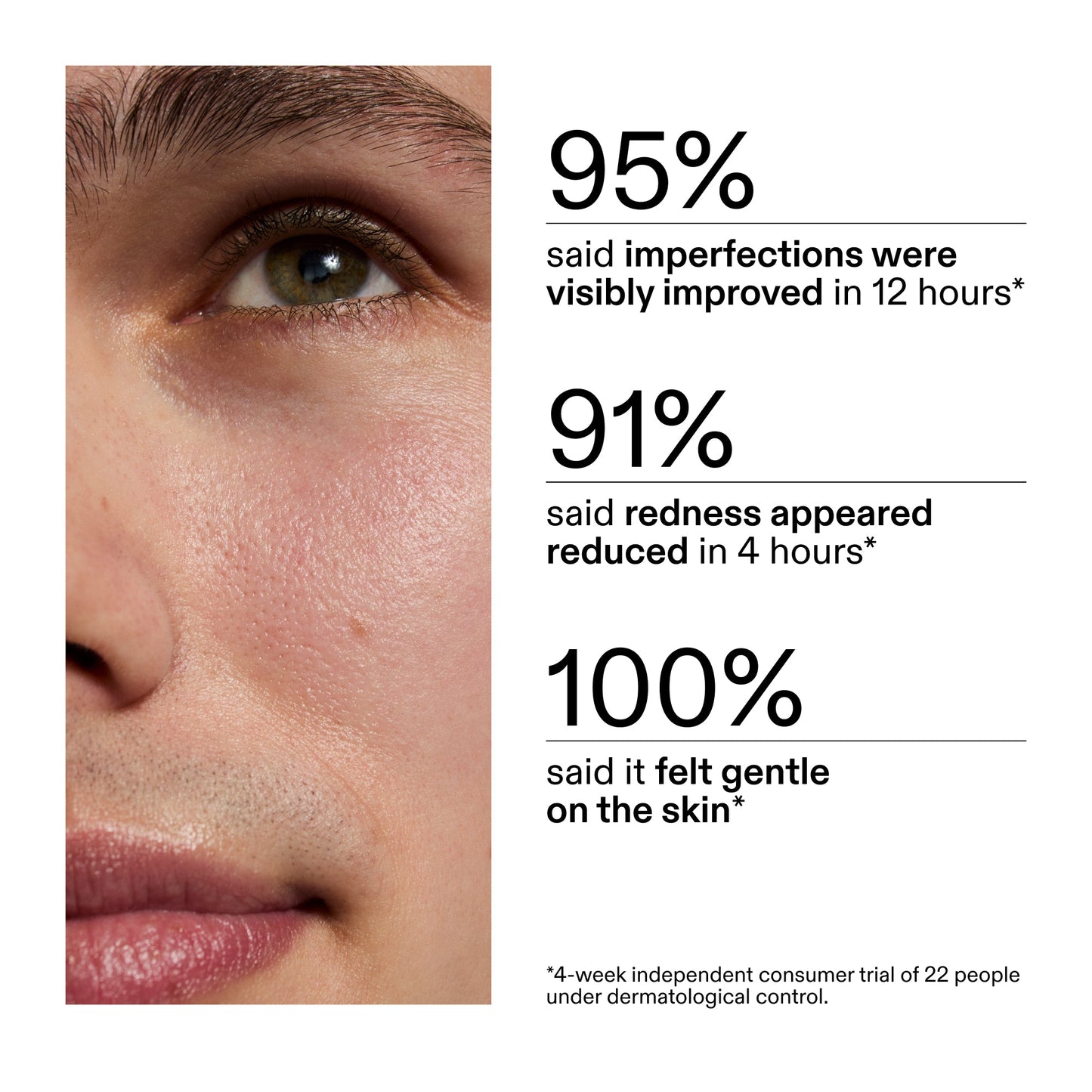 succinic-acid-acne-treatment-w2 CA_Succinic_Acid_Treatment_key_Claims_2000x2000_db91b0f1-7f29-4bfe-bb16-63a47f500960.jpg