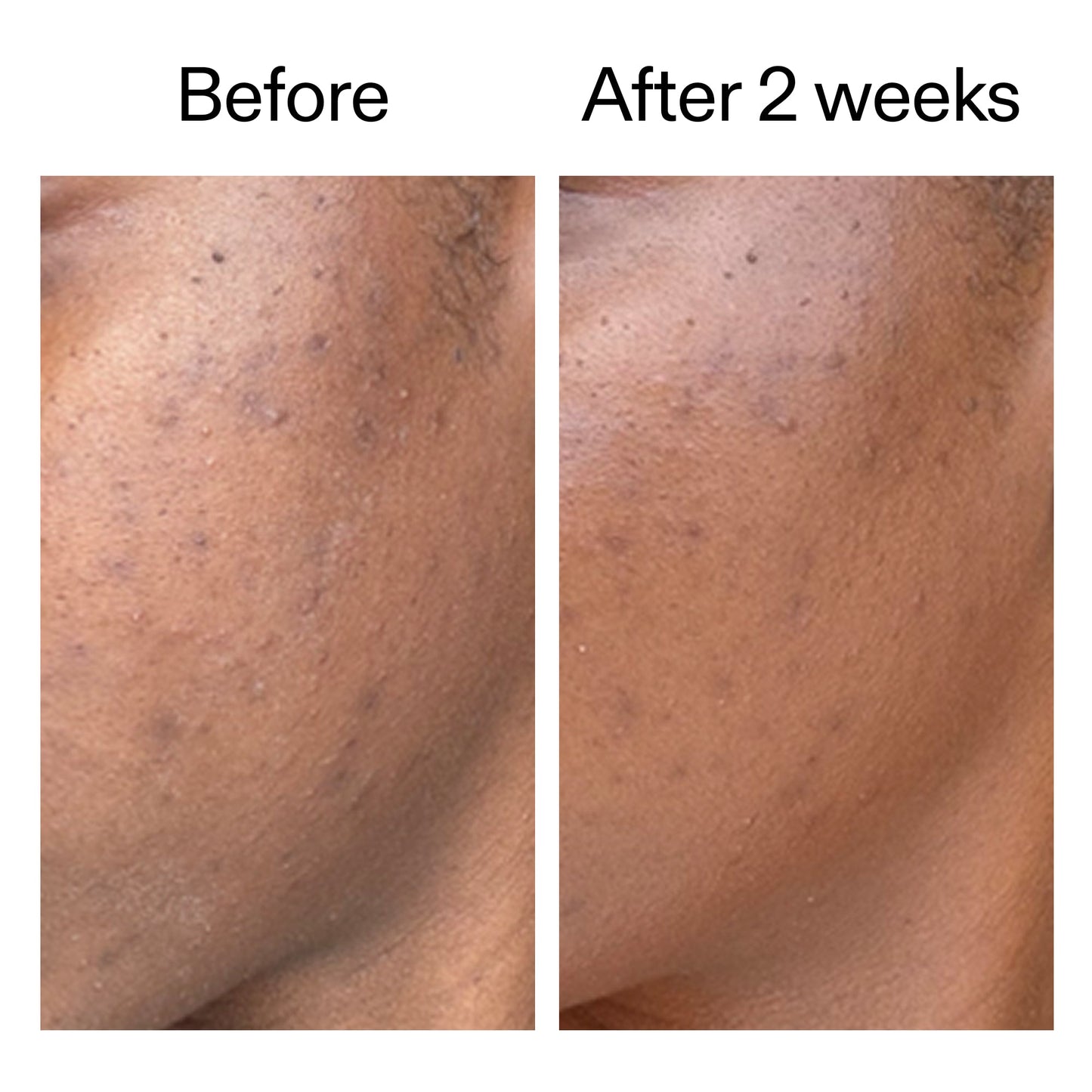 360-acne-clearing-serum-f4 DIOICB_A2000x2000.jpg