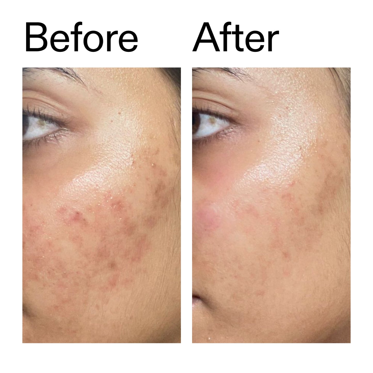 ectoin-hydro-barrier-serum-u1 Ectoin_Hydro-barrier_Serum__Before_After_2000x2000_34261920-d004-48d0-9c7b-8e1c15971bfd.jpg