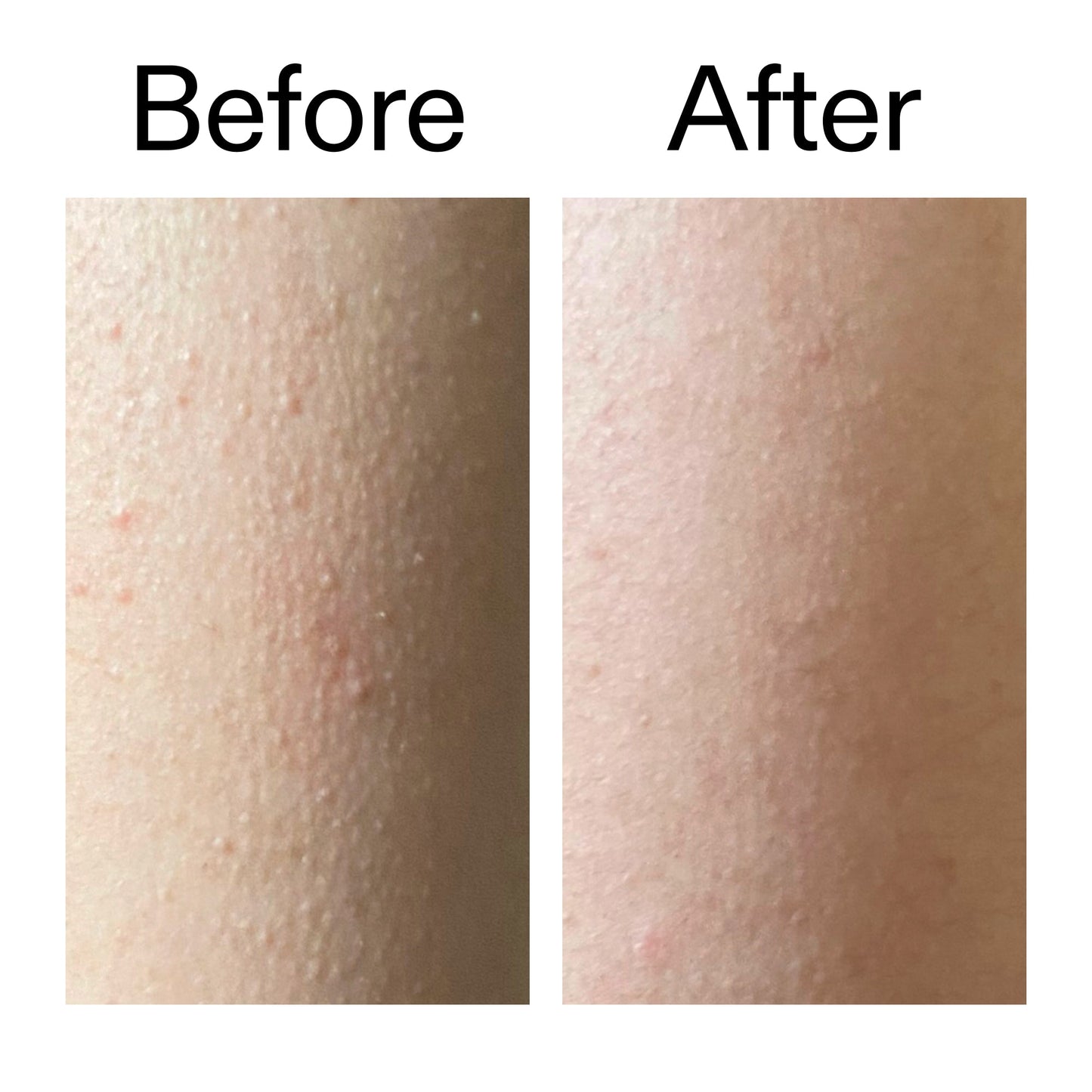 glycolic-acid-exfoliating-body-stick-e2 Glycolic_Acid_Exfoliating_Body_Stick_Before_After_V2_2000x2000_2e4ba052-94f6-4d56-82df-7bdb5b2df7ae.jpg