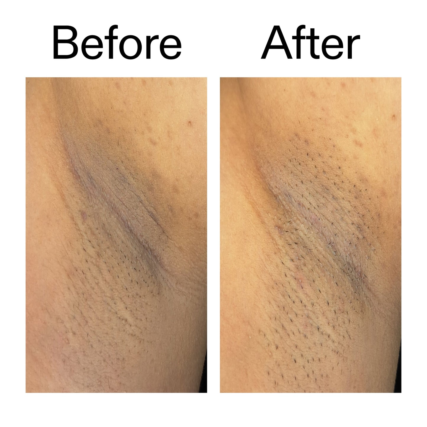 glycolic-acid-exfoliating-body-stick-e2 Glycolic_Acid_Exfoliating_Body_Stick_Before_After_V3_2000x2000_ea919cd9-1439-4a46-82a0-76200eb5bb42.jpg