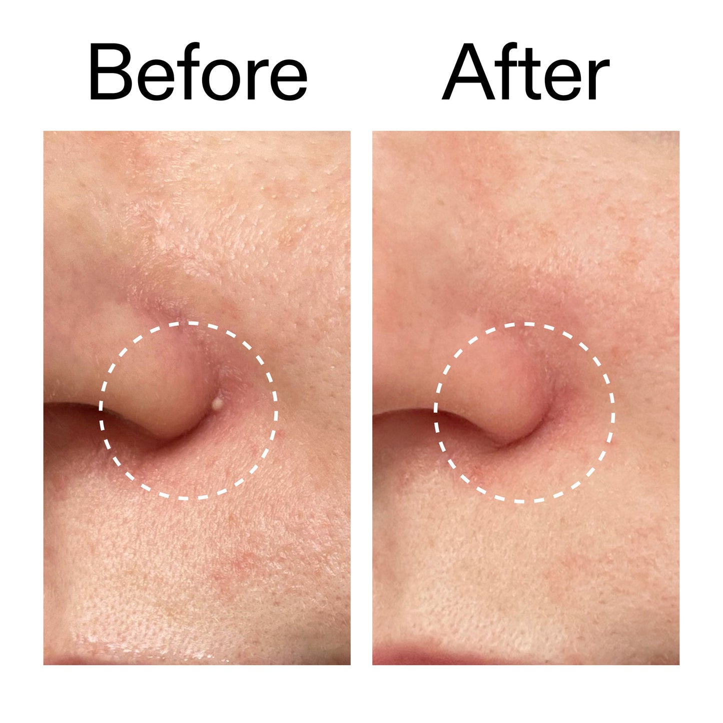 hydrocolloid-invisible-pimple-patches-pack-of-44-q7 Hydrocolloid_Invisible_Pimple_Patches_Before_After_2000x2000_b02aa37b-c78a-4682-91de-9135af5bb7df.jpg