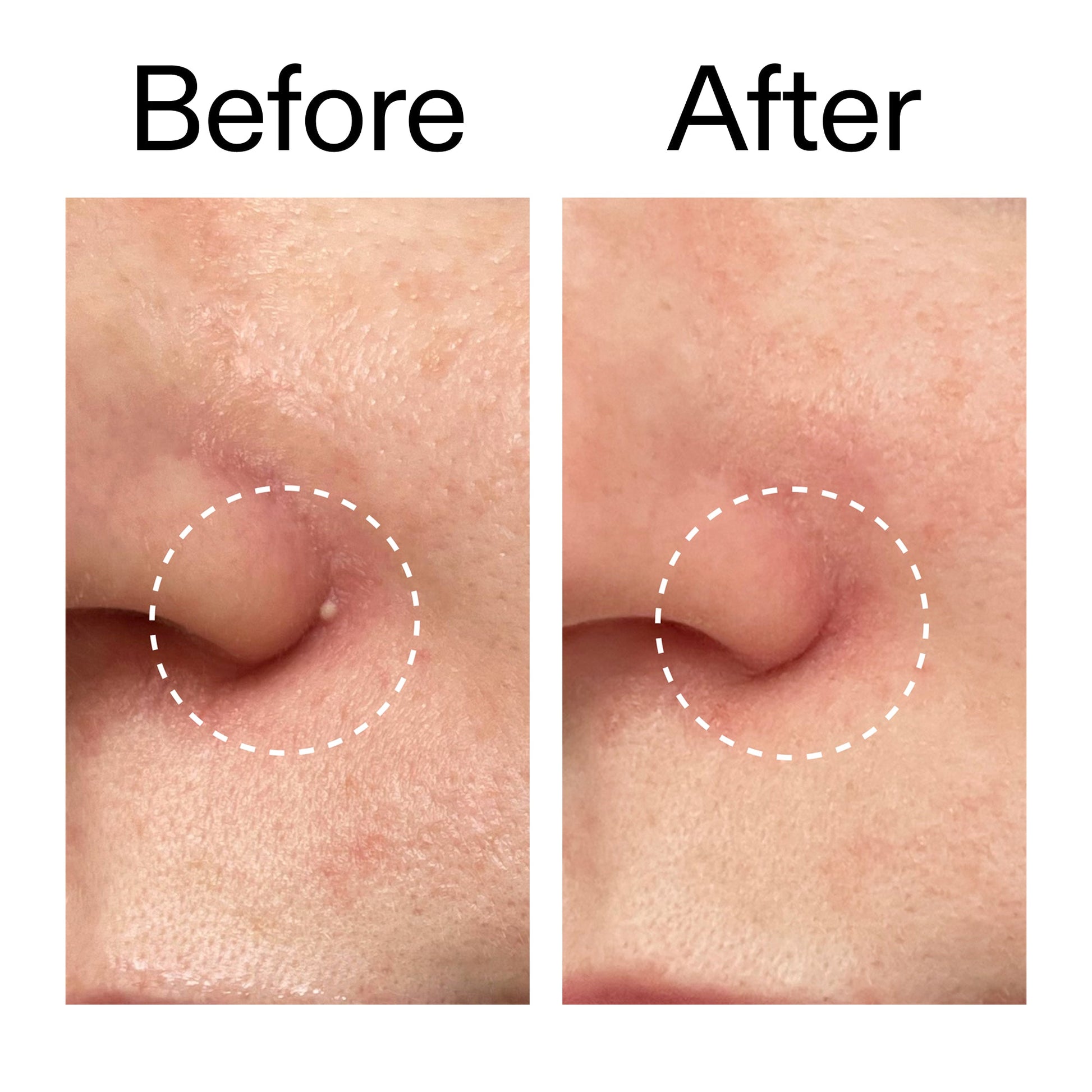 hydrocolloid-invisible-pimple-patches-pack-of-44-q7 Hydrocolloid_Invisible_Pimple_Patches_Before_After_2000x2000_b02aa37b-c78a-4682-91de-9135af5bb7df.jpg