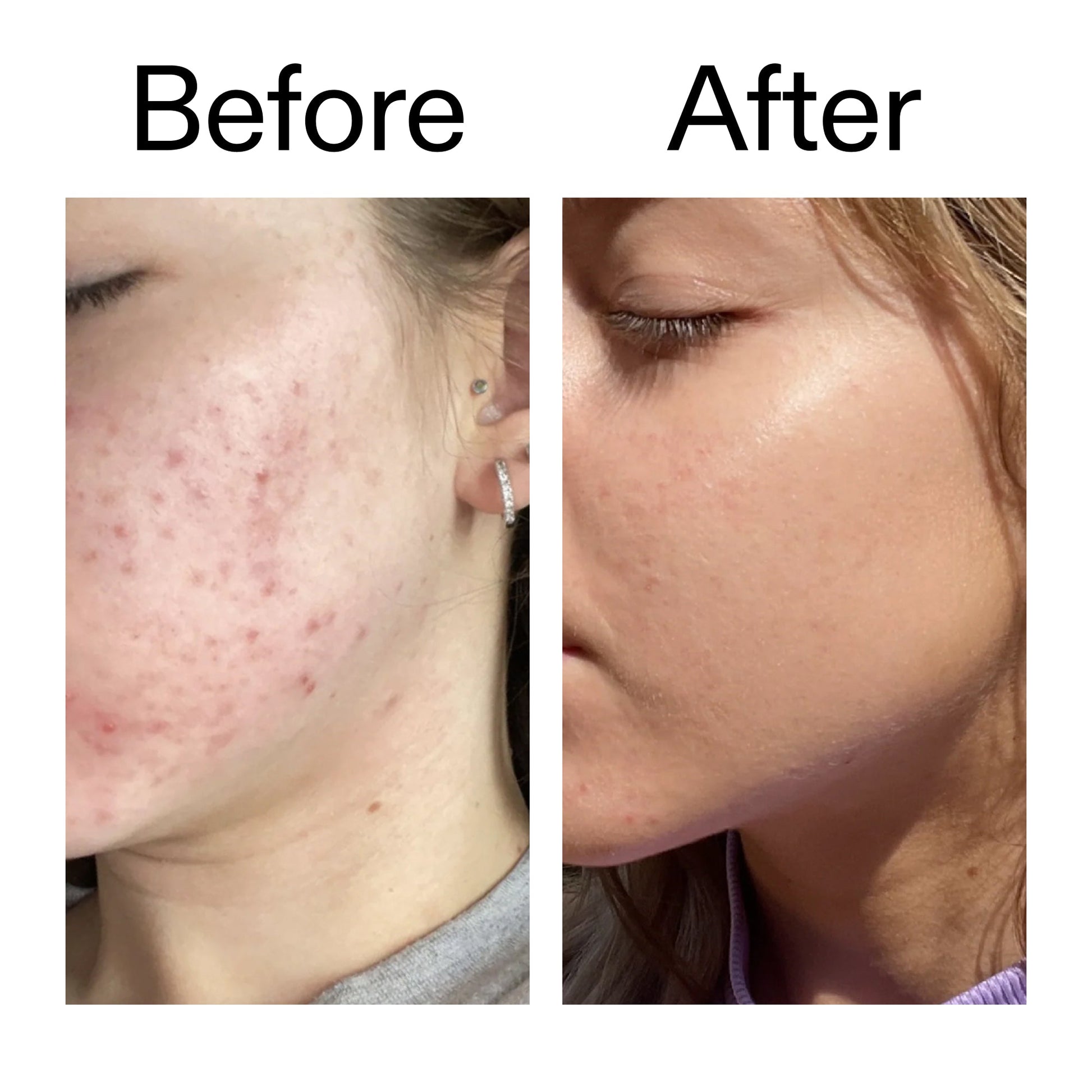 10-niacinamide-serum-duo-l2 Niacinamide_Serum_Before_After_2000x2000_bde32455-9e7d-448e-b053-bef41504f0a9.jpg