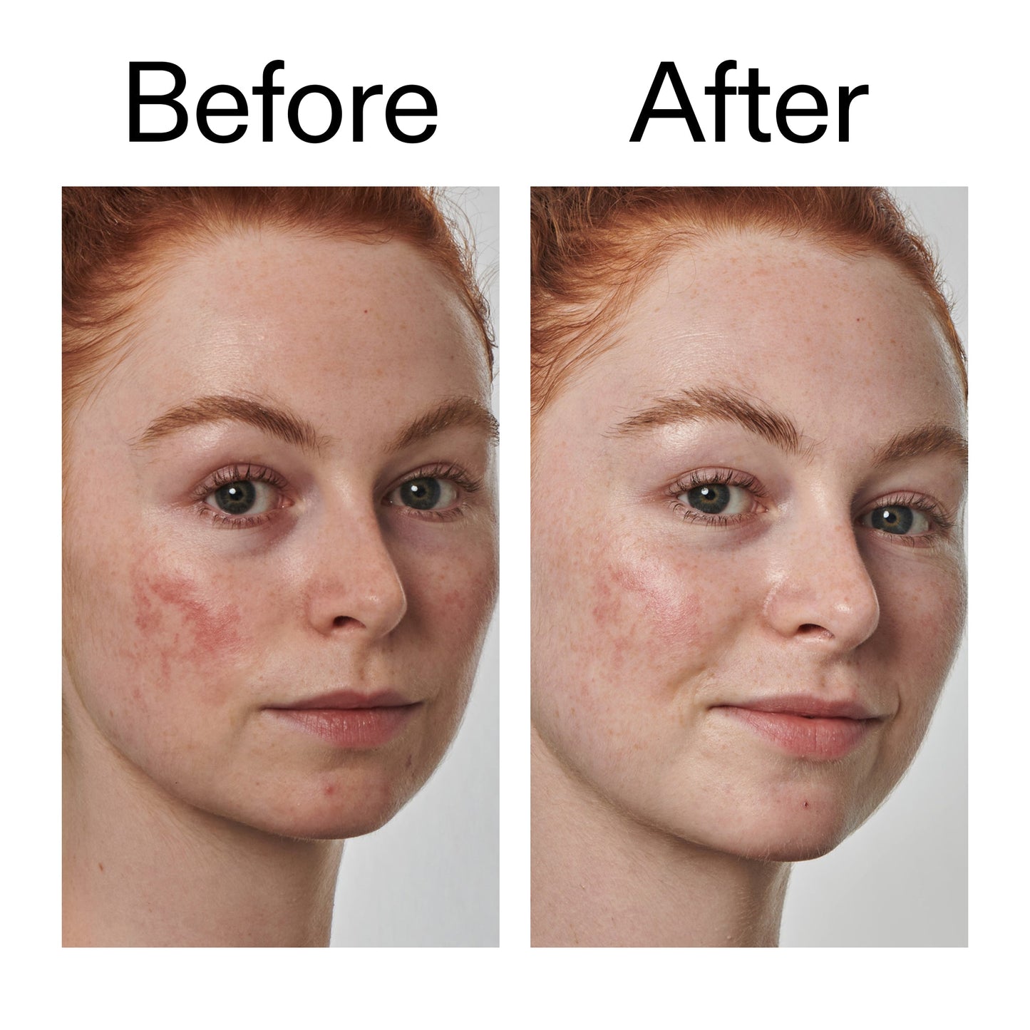 10-azelaic-acid-serum-for-redness-relief-y3 Redness_Relief_Serum_Before_After_2000x2000_3334dc9a-cce9-4e00-8aec-7ad89ca051f2.jpg