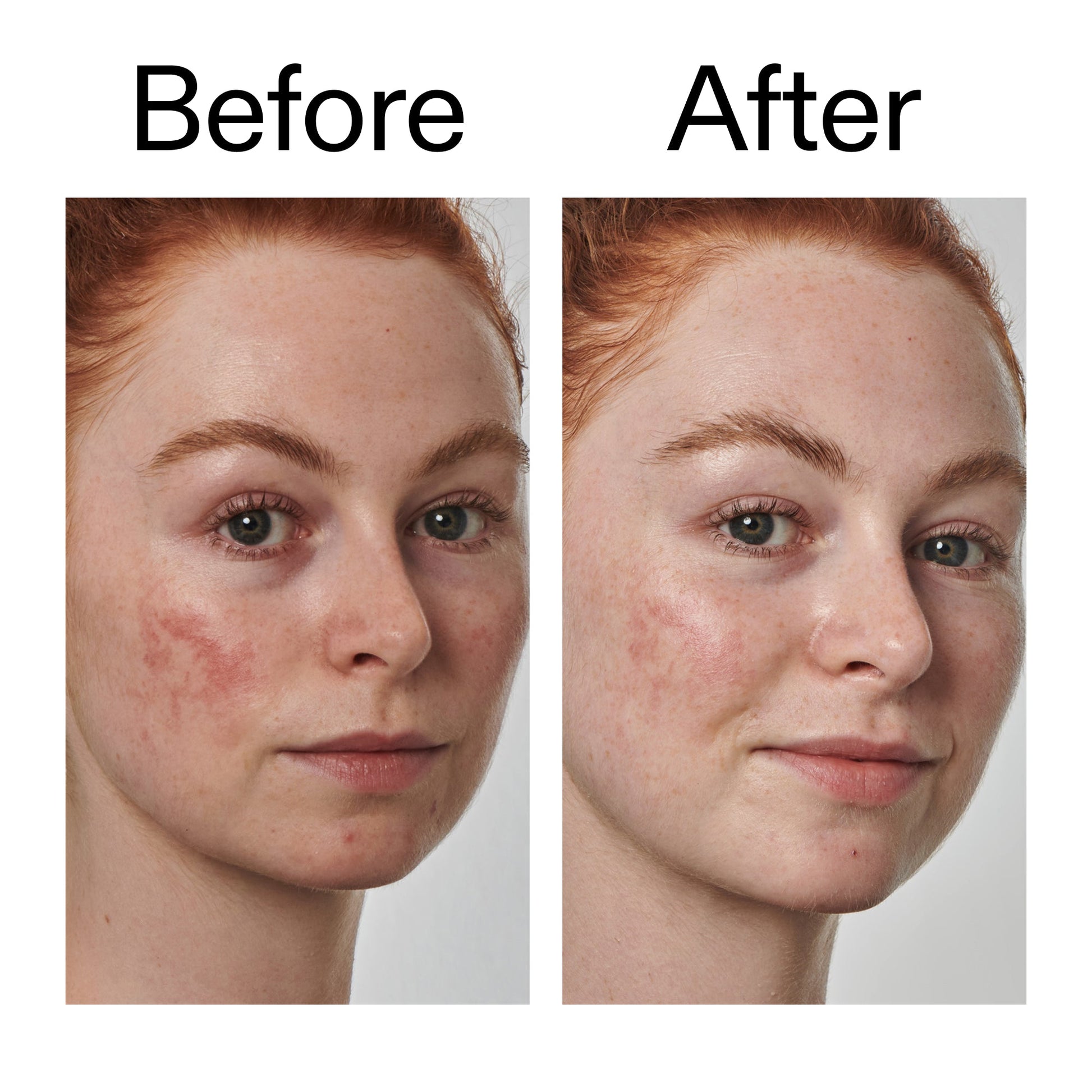 10-azelaic-acid-serum-for-redness-relief-y3 Redness_Relief_Serum_Before_After_2000x2000_3334dc9a-cce9-4e00-8aec-7ad89ca051f2.jpg