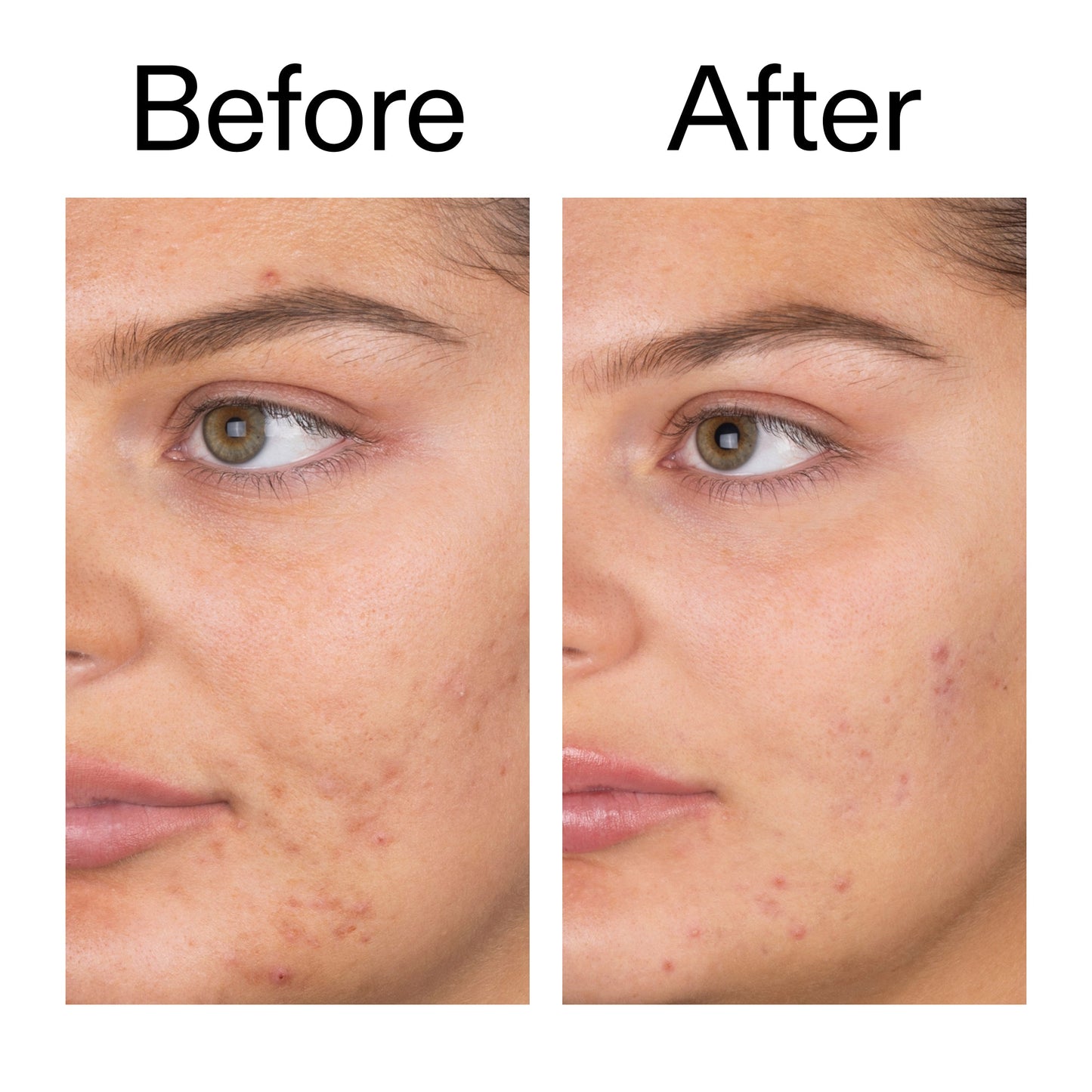 salicylic-acid-cleanser-duo-f1 Salicylic_Acid_Cleanser_-_150ml_Before_After_2000x2000_e7230494-853f-4b07-82b1-27669104c995.jpg