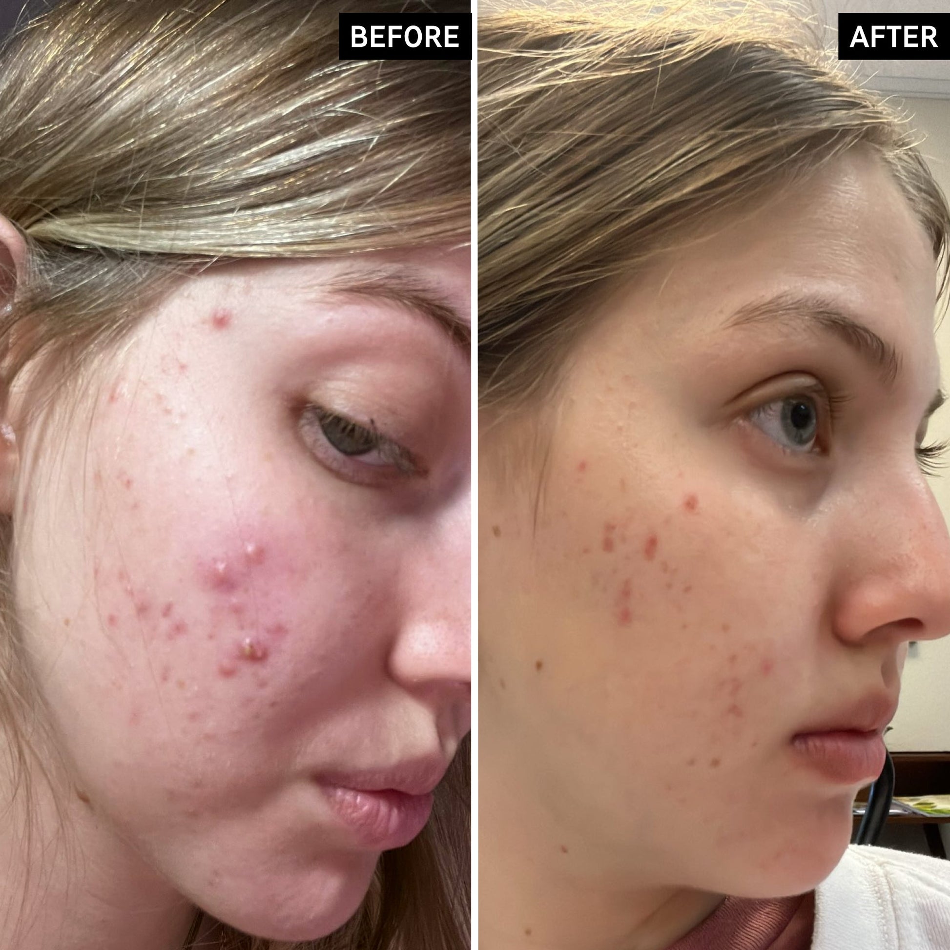 salicylic-acid-cleanser-duo-f1 SamanthaB_A_2000x2000_54062586-cec1-44d9-a20a-bda2c4f03f5f.jpg
