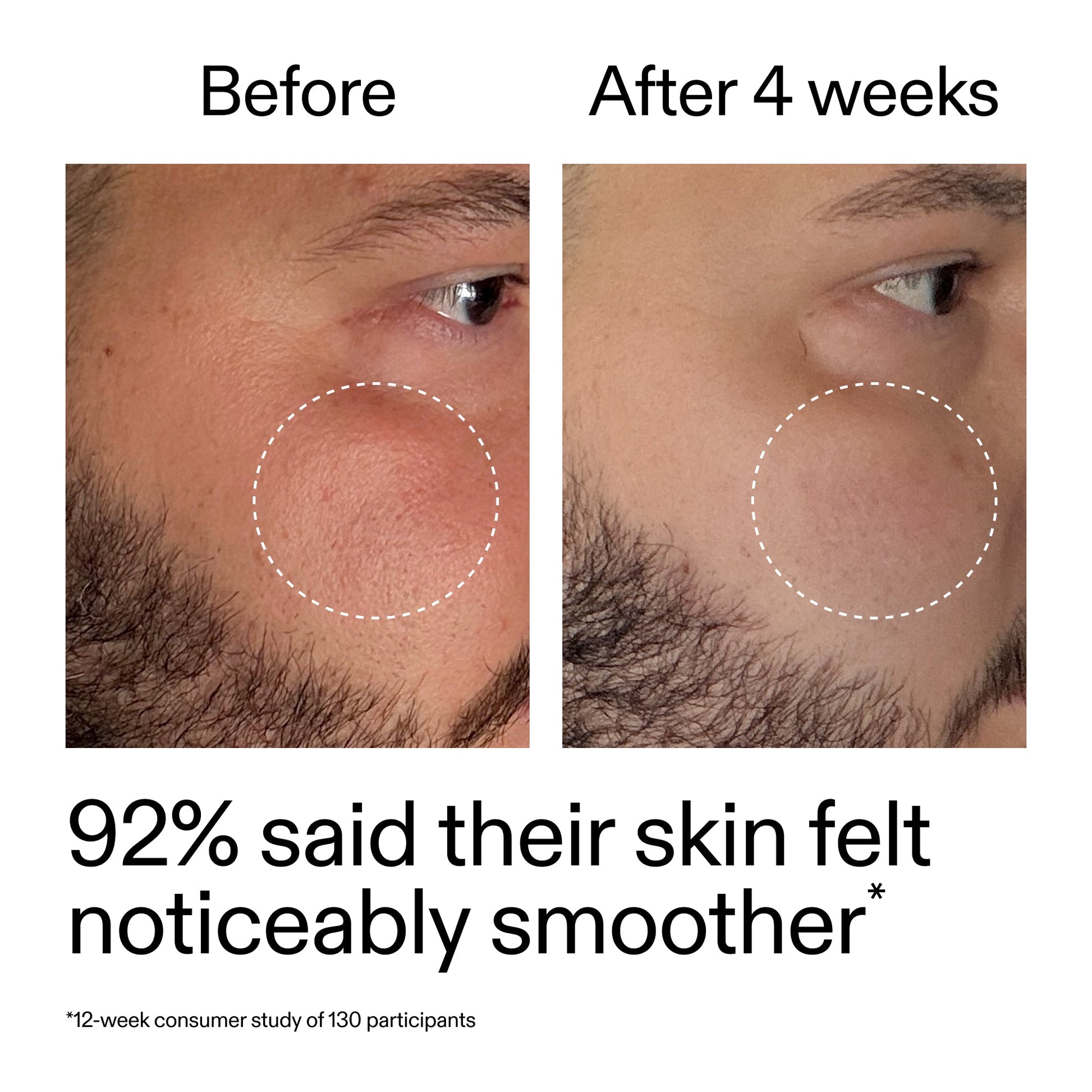 starter-retinol-serum-e8 StarterRetinol_BeforeAfter_Claim3_2000x2000_6ceab106-e0ee-4ed4-ba62-41bc39538038.jpg