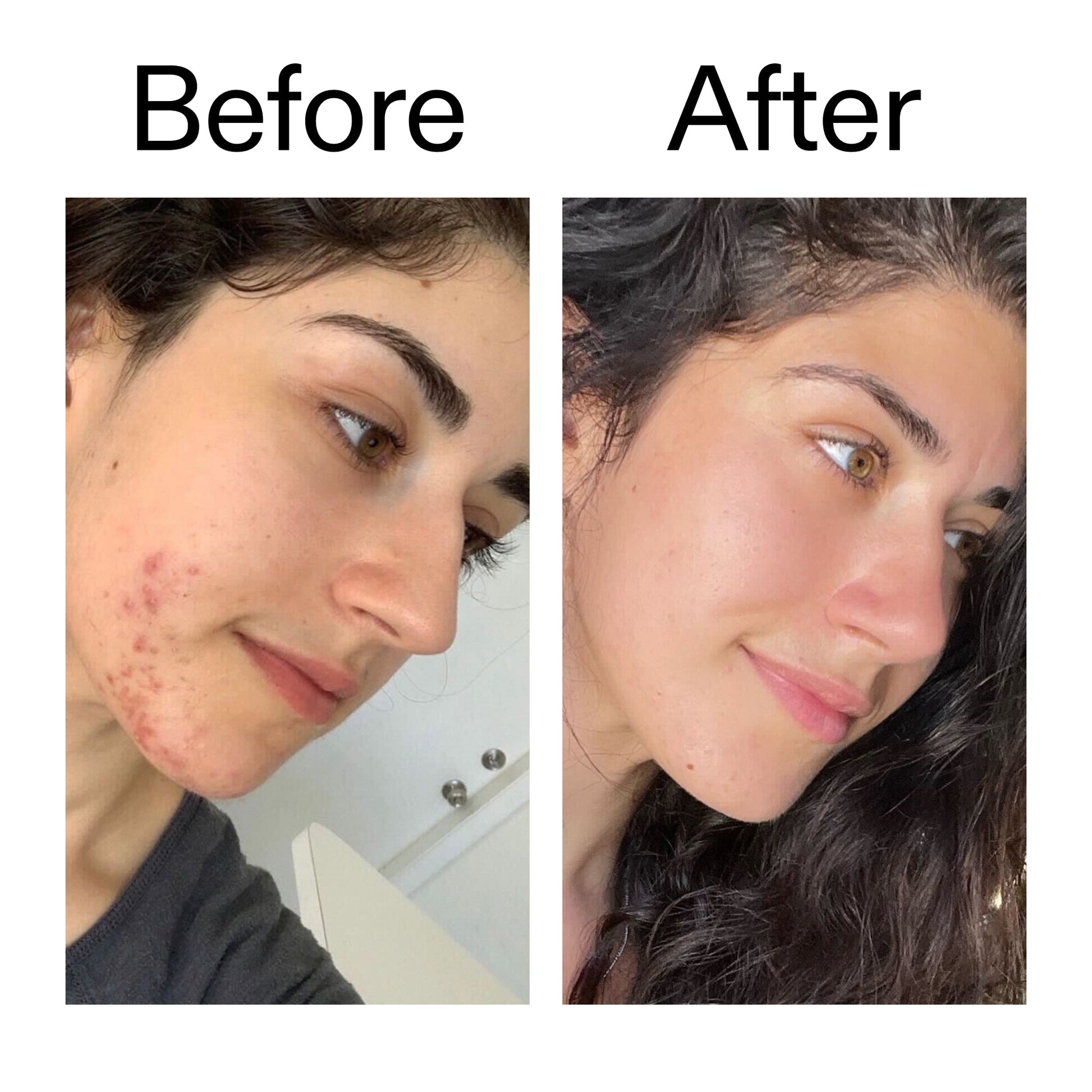succinic-acid-acne-treatment-w2 Succinic_Acid_Treatment_Before_After_2000x2000_6a5f0054-2f58-4433-9314-0dc72c9bdd3b.jpg